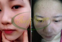 Trị Mụn Đầu Đen, mụn ẩn sâu trong da, mụn cám trên mũi, mụn li ti - MSKH: TN1066